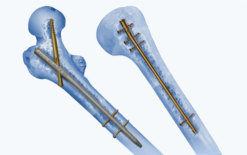 Expert Adolescent Lateral Femoral Nail. - Synthes